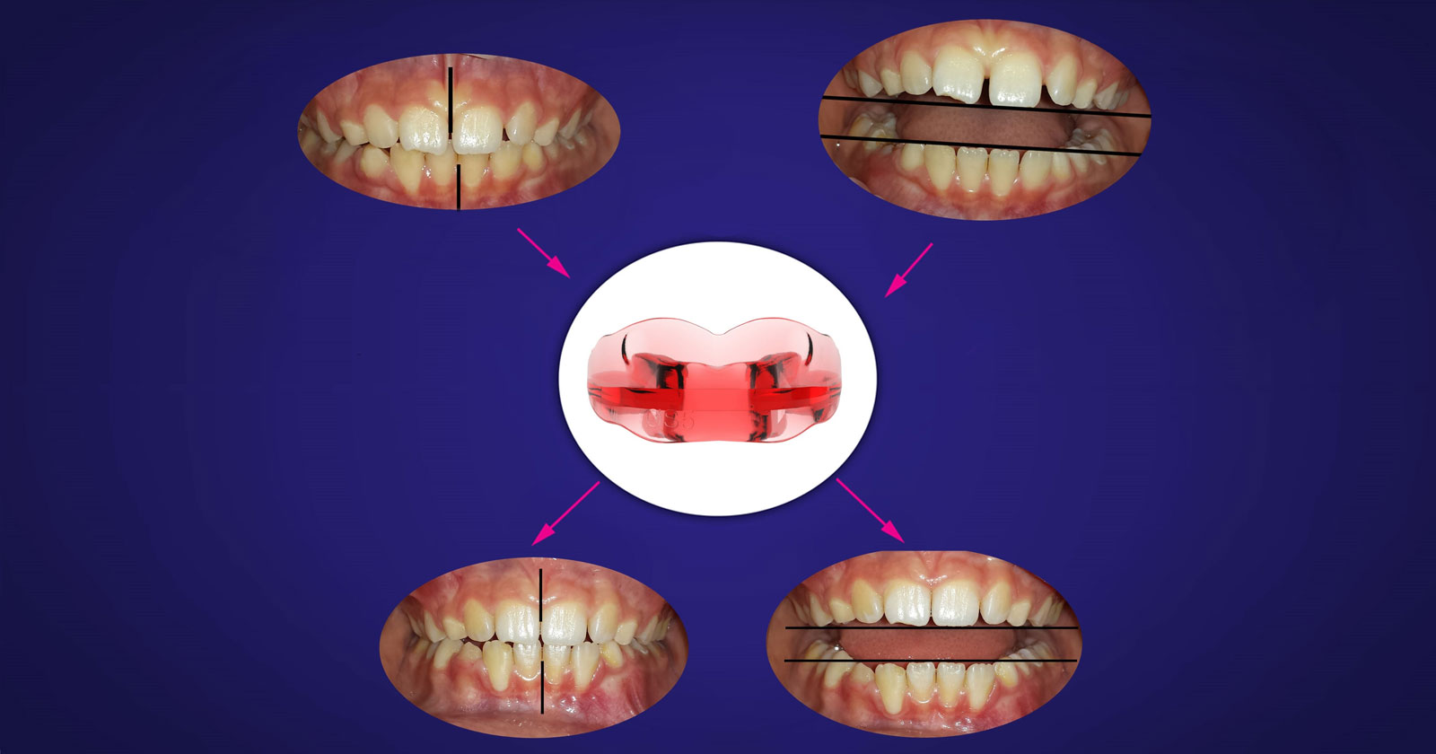 Deviate le arcate dentarie e latero-deviato in latero-flessioni